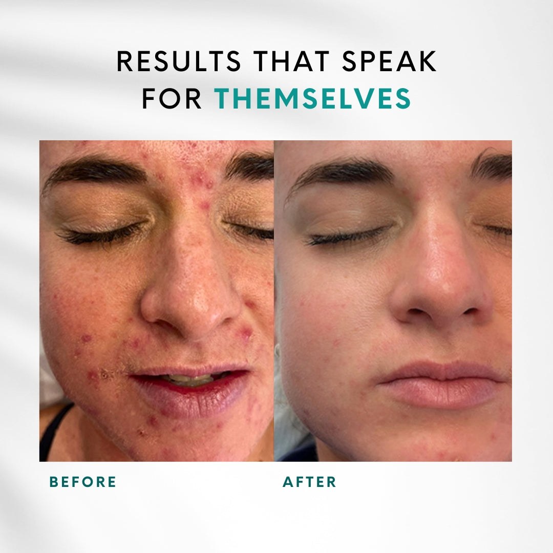 Green Peel | 1 Peel + 1 IPL Laser Facial FREE