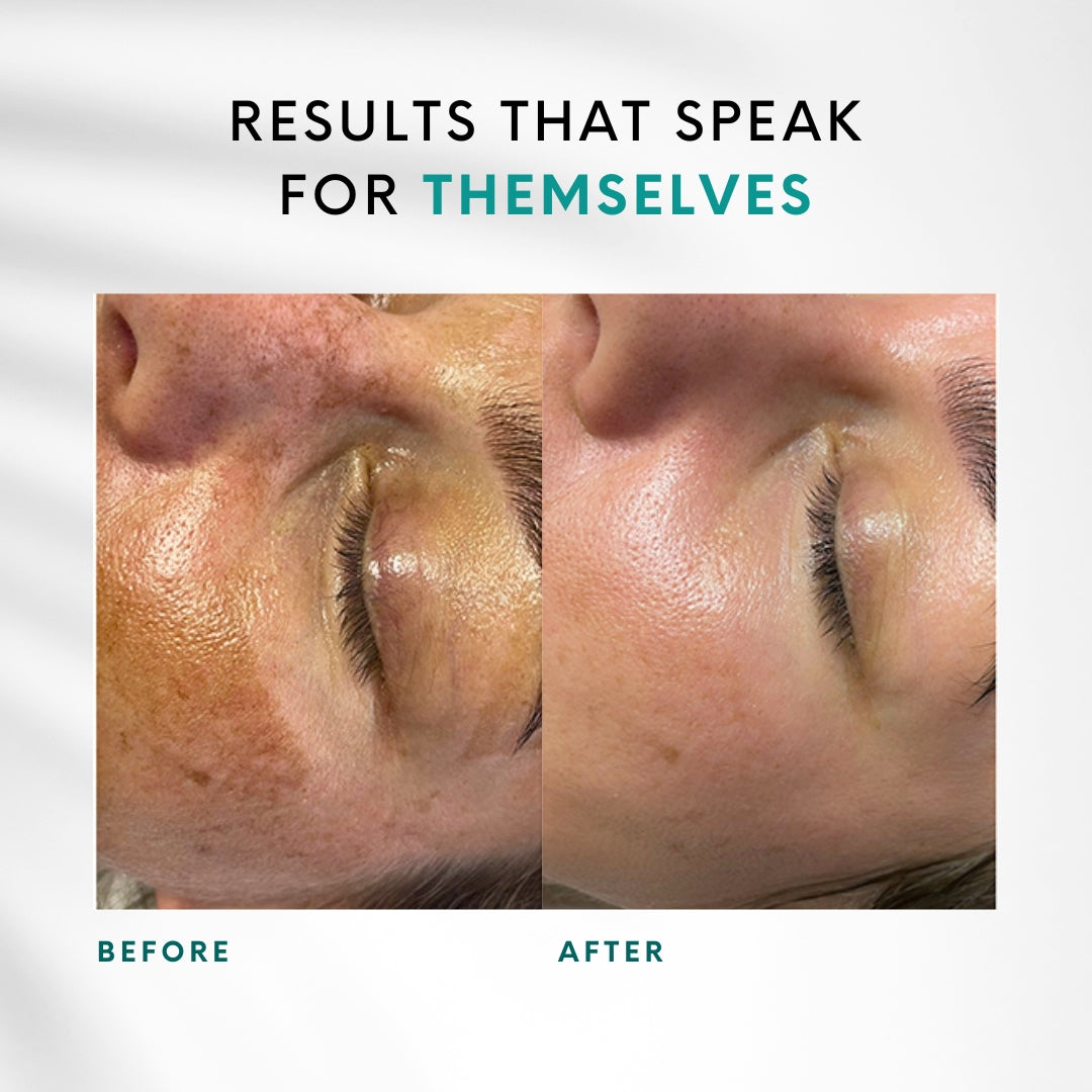 Green Peel | 1 Peel + 1 IPL Laser Facial FREE