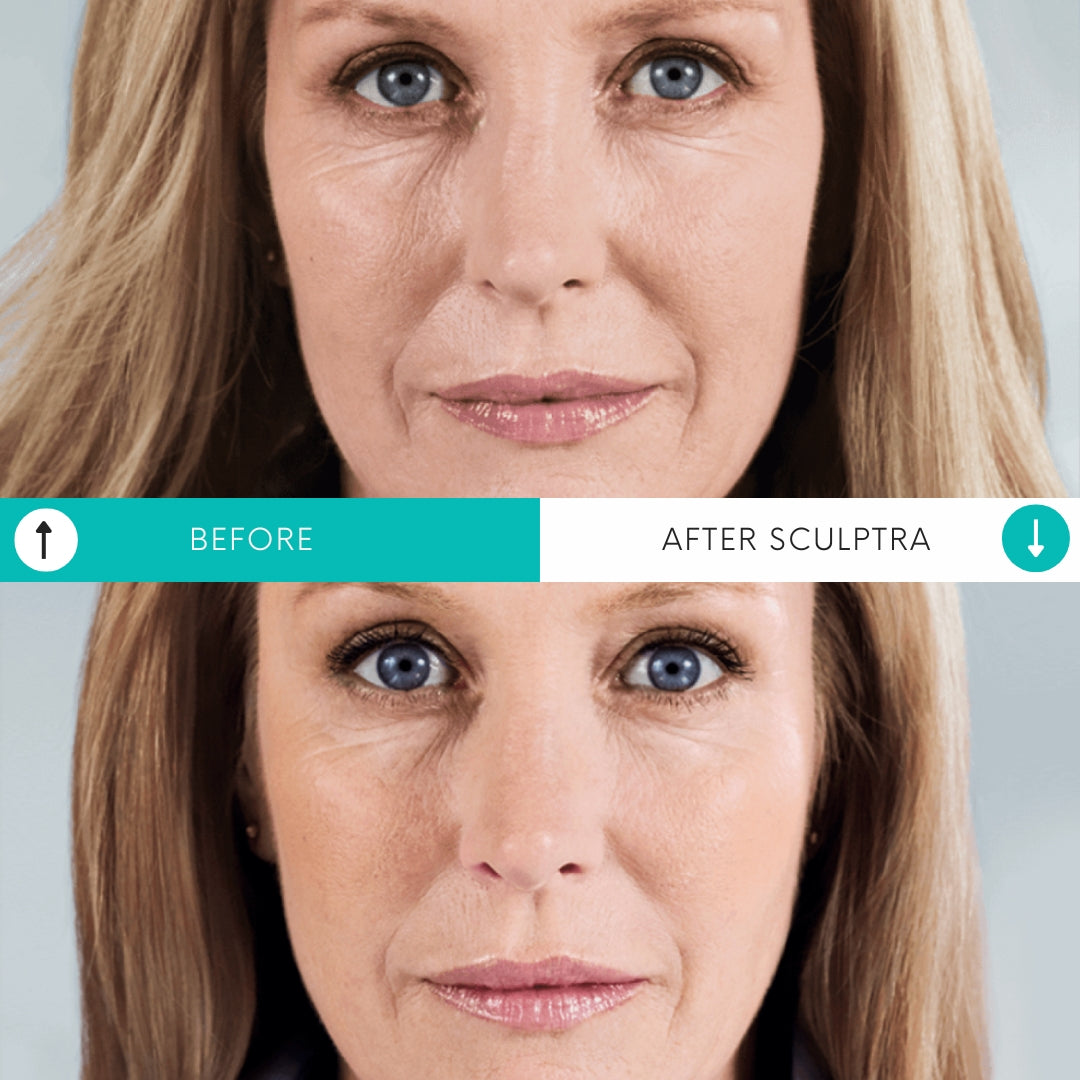Combo de relleno | 1 vial de Scuptra + 1 jeringa de relleno de Restylane