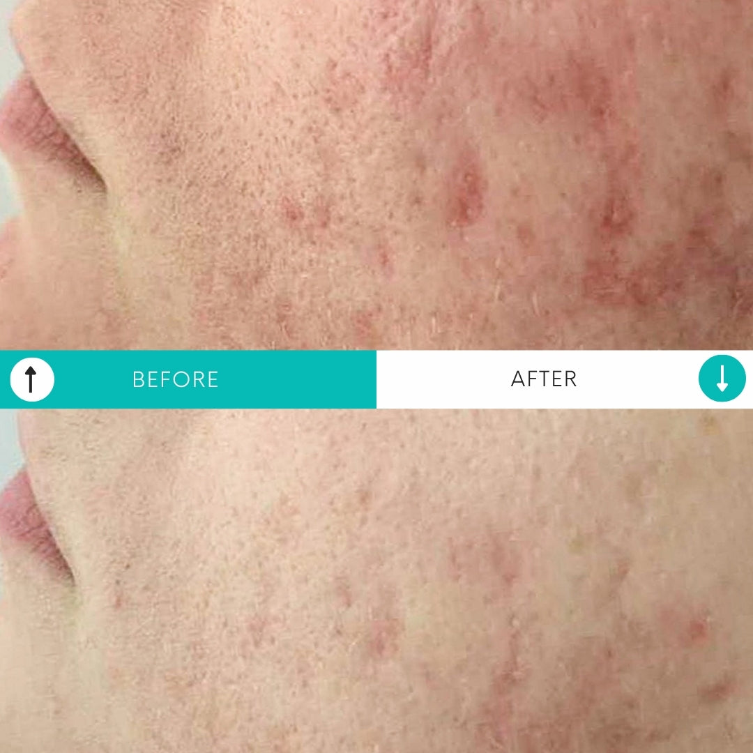 Paquete Piel Impecable | 3 Peelings BioRePeelCl3 + 3 Tratamientos de Microagujas SkinPen