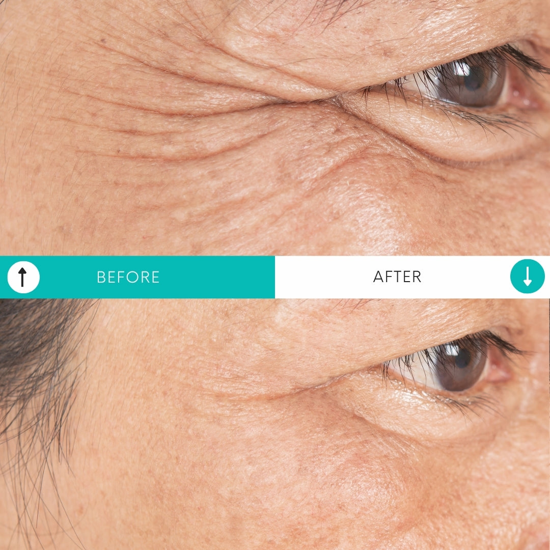 All About The Eyes | BOGO PRP Under Eyes + Morpheus8 Under Eye Resurfacing Treatments