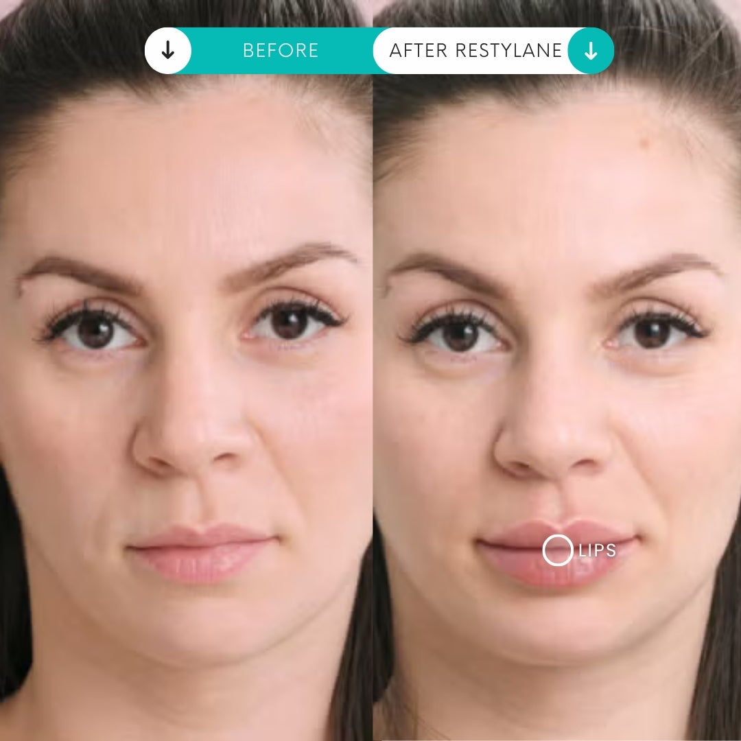 Combo de relleno | 1 vial de Scuptra + 1 jeringa de relleno de Restylane
