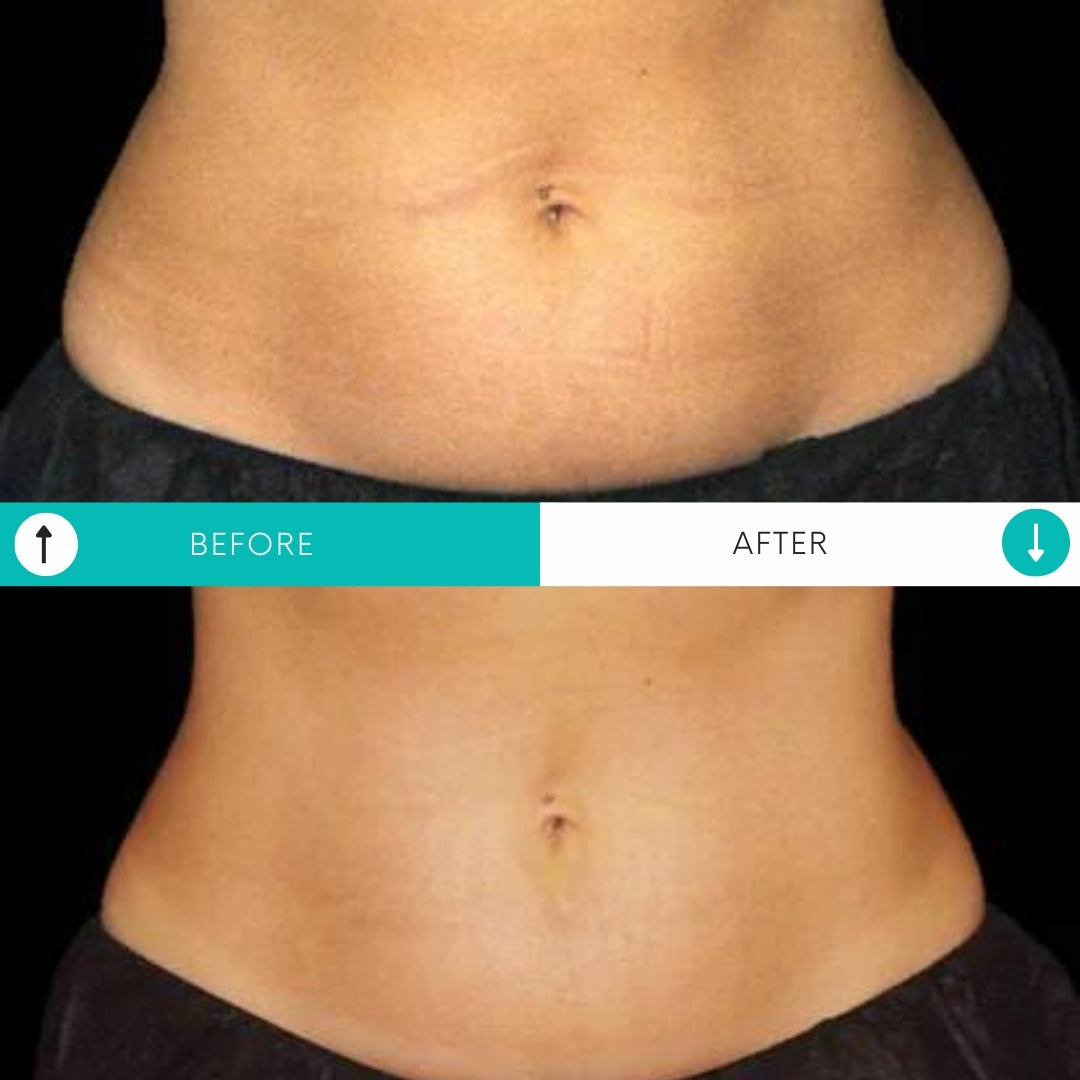 Emsculpt NEO | Buy 3, Get 1 FREE!