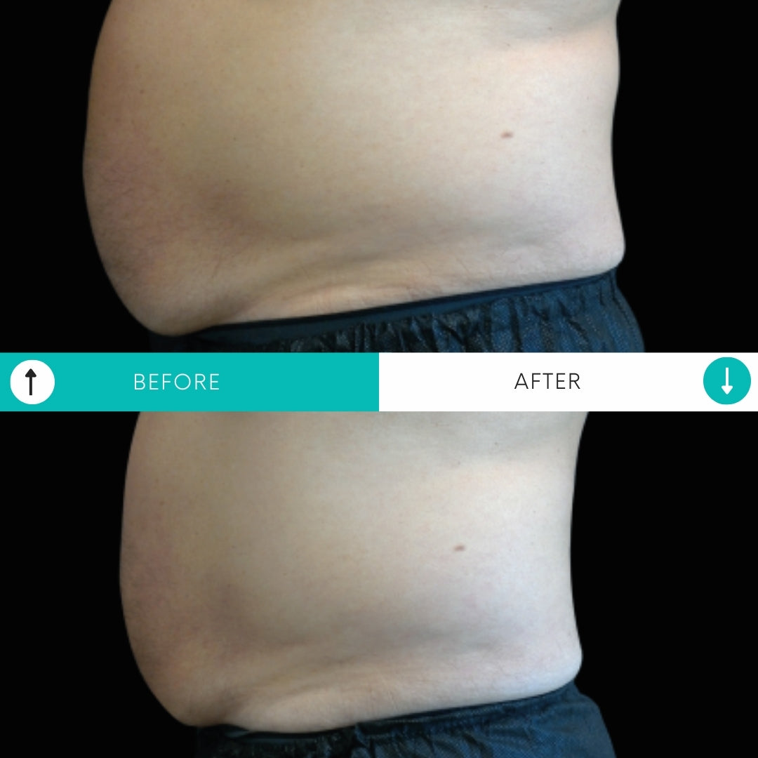 Emsculpt NEO | Buy 3, Get 1 FREE!