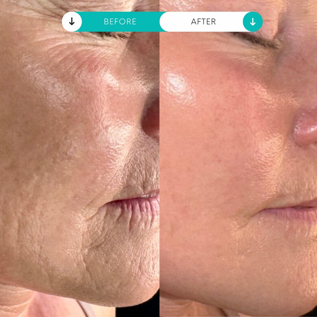 Paquete Piel Impecable | 3 Peelings BioRePeelCl3 + 3 Tratamientos de Microagujas SkinPen