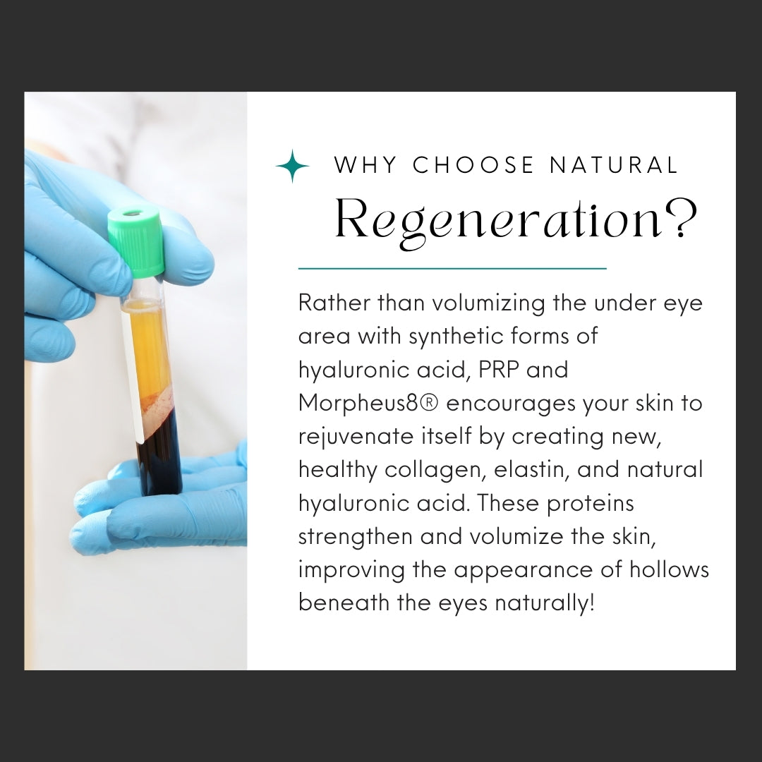All About The Eyes | BOGO PRP Under Eyes + Morpheus8 Under Eye Resurfacing Treatments