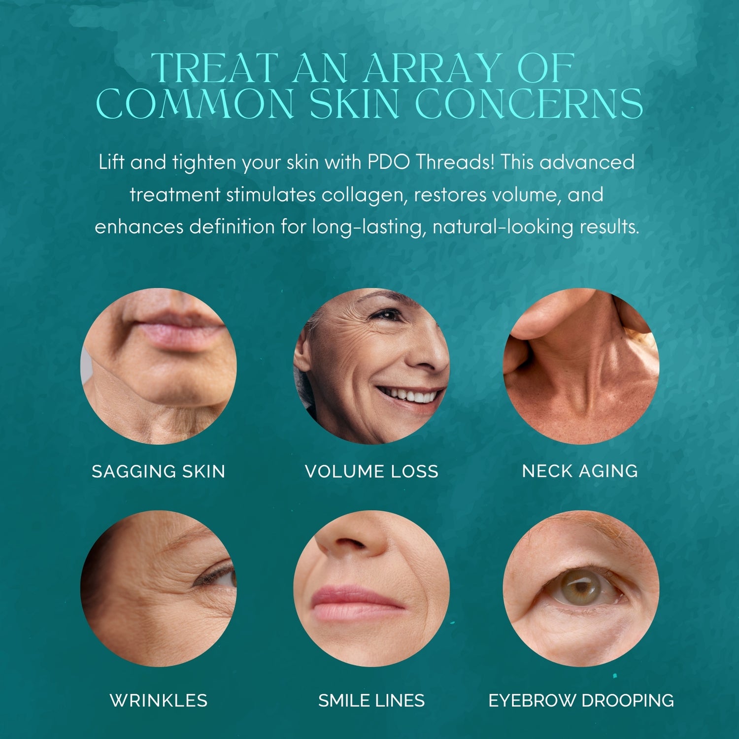 PDO Threads Mid &amp; Lower Face Lift | Tighten, Tone with a Mini-Face Lift in 90 Minutes. No Fillers, No Surgery, Just an Instant Lift.