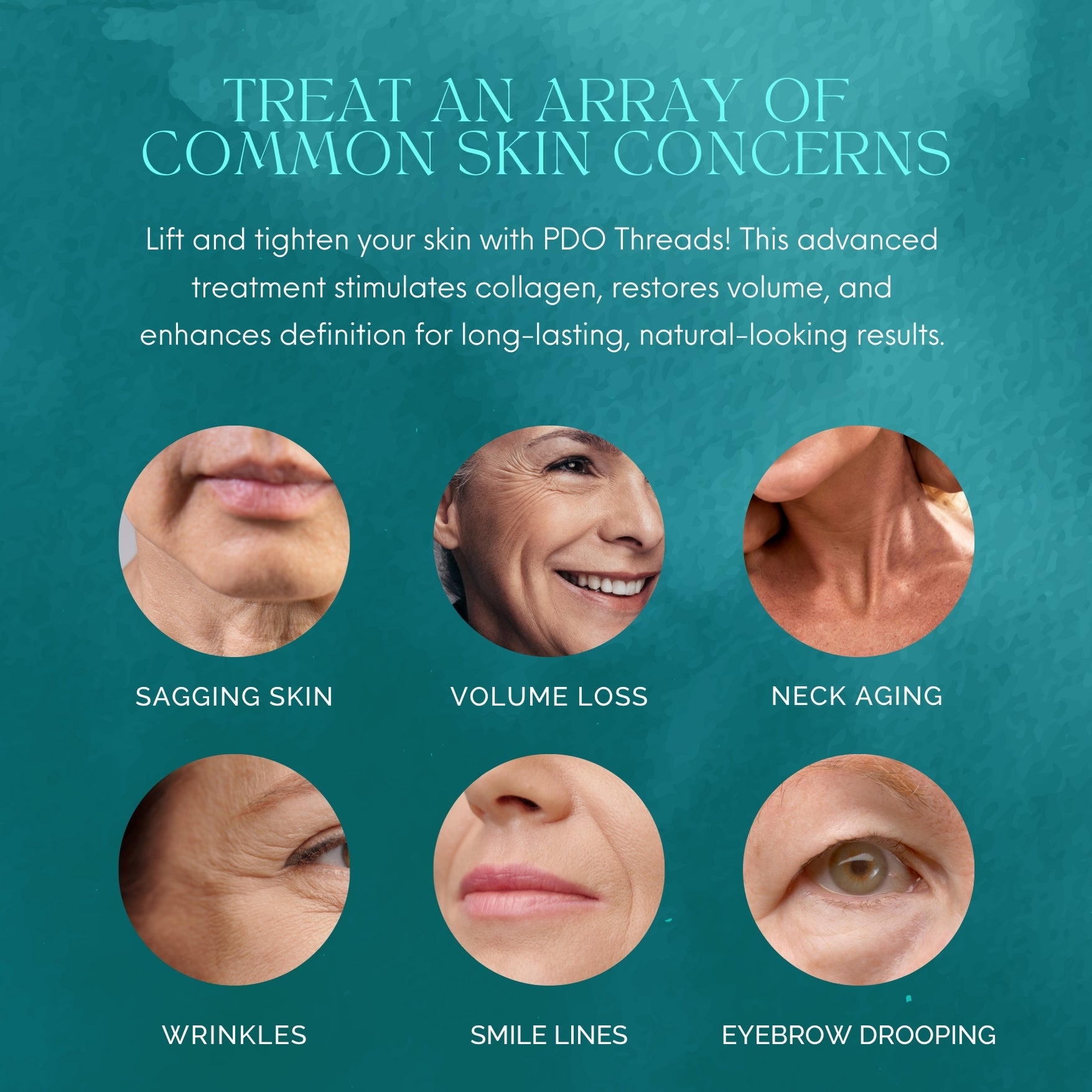 PDO Threads Mid &amp; Lower Face Lift | Tighten, Tone with a Mini-Face Lift in 90 Minutes. No Fillers, No Surgery, Just an Instant Lift.
