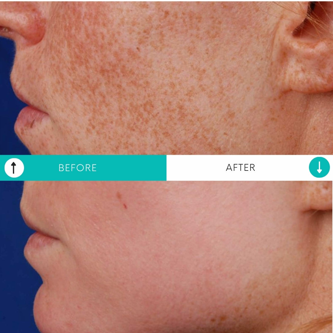 Laser Genesis | Buy 1, Get 1 FREE