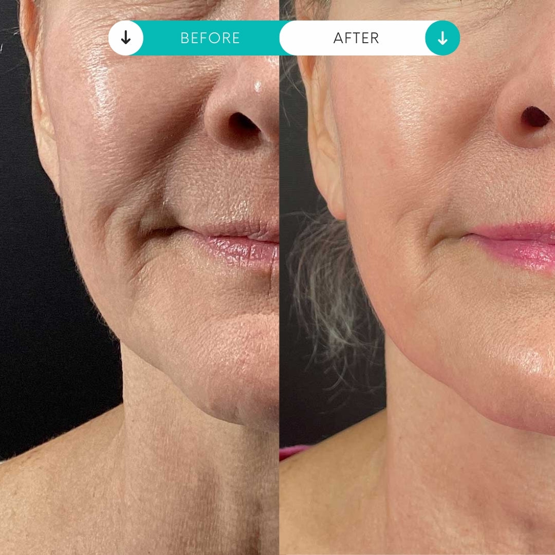 Morpheus8® | Buy 2 Treatments, Get 1 FREE