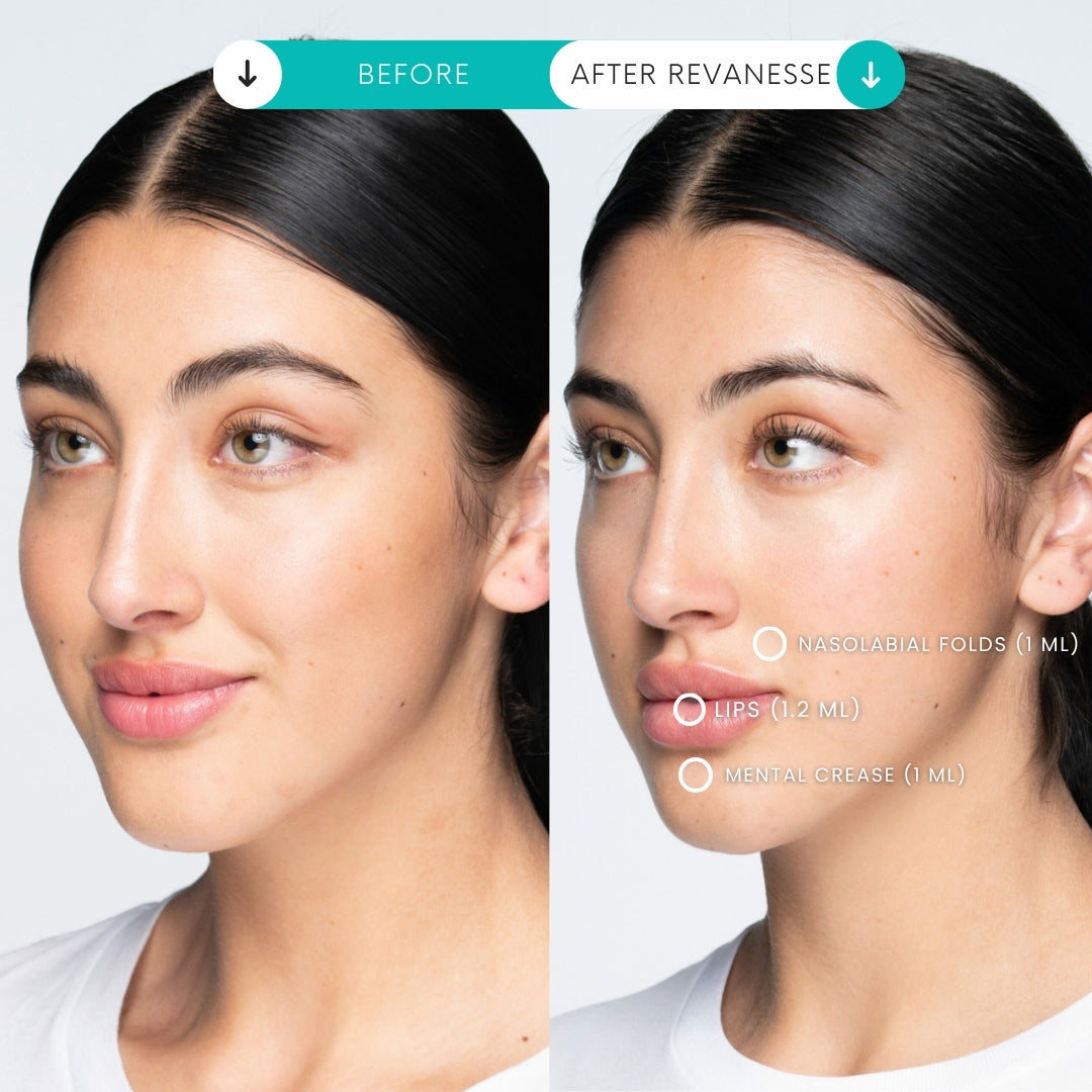 Filler | 1 Syringe + 1 Area Xeomin FREE