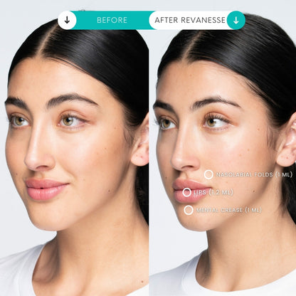 Filler | 1 Syringe + 1 Area Xeomin FREE