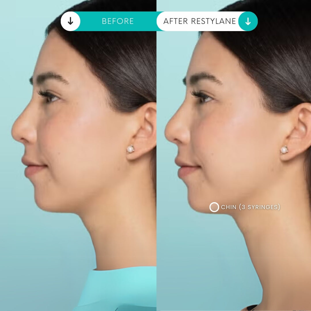 Filler | 1 Syringe + 1 Area Xeomin FREE