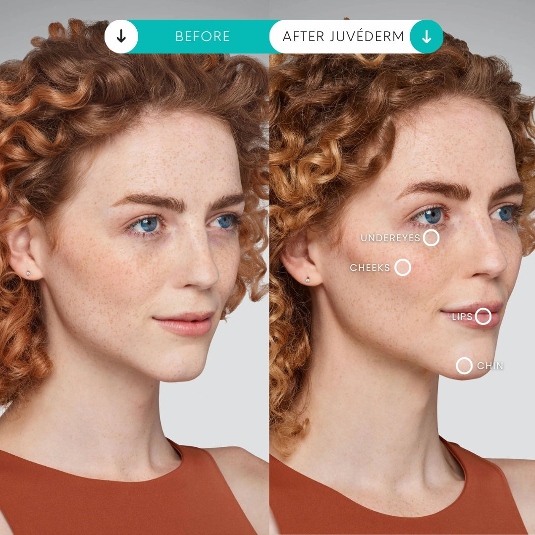 Filler | 1 Syringe + 1 Area Xeomin FREE