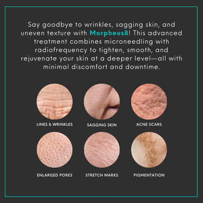 Morpheus8® | Buy 2 Treatments, Get 1 FREE