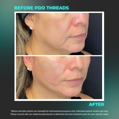 PDO Threads Mid &amp; Lower Face Lift | Tighten, Tone with a Mini-Face Lift in 90 Minutes. No Fillers, No Surgery, Just an Instant Lift.
